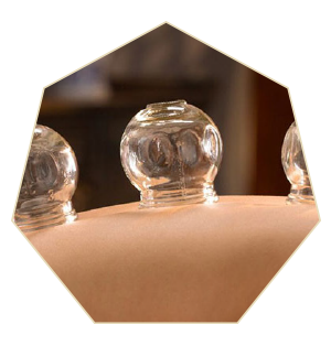 Monterey Acupuncture Cupping Treatment
